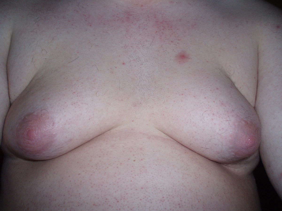 File:Gynecomastia 12.jpg