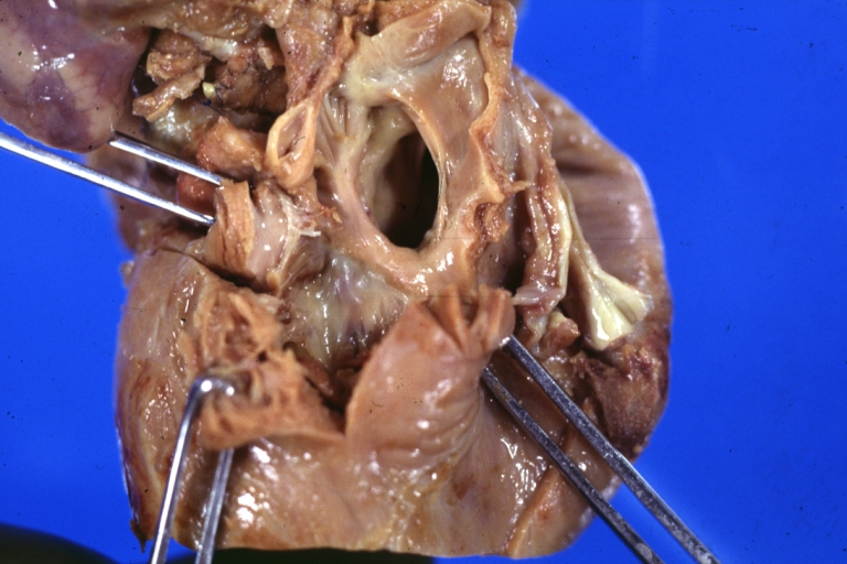 Hypoplastic left ventricle