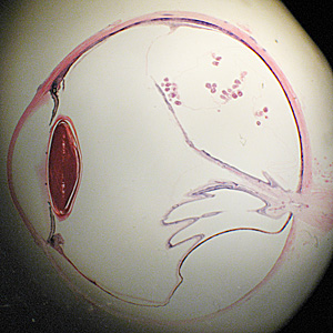 Cross-section of a human eye, showing multiple protoscoleces within a coenurus. Adapted from CDC