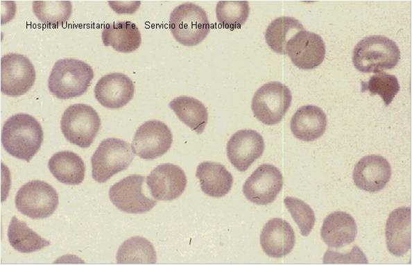 Microangiopathic hemolytic anemia