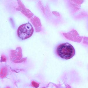 Cross-sections of larvae of S. stercoralis in a intestinal biopsy specimen, stained with H&E. Image taken at 1000x oil magnification. The patient was infected with Strongyloides following transplant of an infected kidney. Adapted from CDC