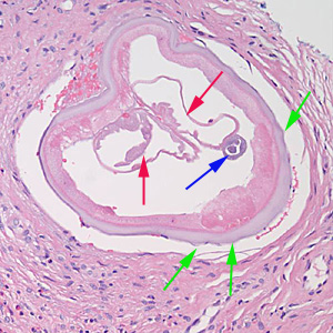 Cross-section of an adult female Onchocerca sp. from the biopsy of a scalp nodule from a patient from Liberia. Note the presence of the intestine (blue arrow), uterine tubes (red arrows) and some cuticular nodules (green arrows). Also notice the weak musculature under the thick cuticle. Image courtesy of Drs. Philip LeBoit and Paul Borbeau. Adapted from CDC