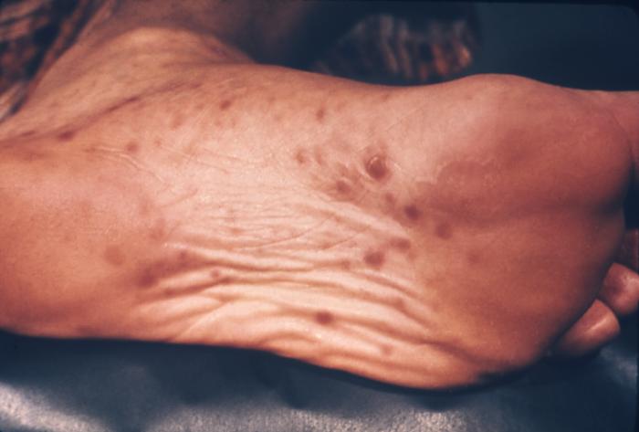 This patient presented with a papulo-squamous rash on the sole of the foot due to secondary syphilis. The second stage starts when one or more areas of the skin break into a rash that appears as rough, red or reddish brown spots both on the palms of the hands and on the bottoms of the feet. Even without treatment, rashes clear up on their own. Adapted from CDC