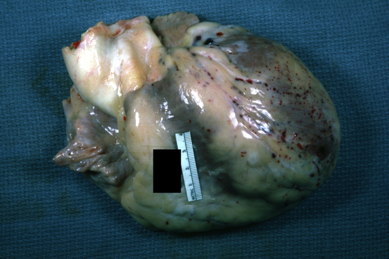 Epicardial petechiae: Gross, an excellent example of infarct heart with petechiae.