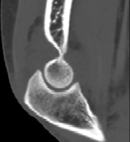 CT demonstrates radial head fracture and joint effusion Image courtesy of RadsWiki and copylefted