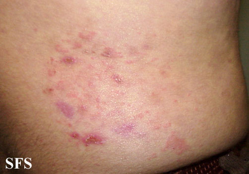 File:Dermatitis herpetiformis15.jpg