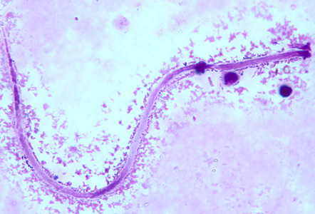 Microfilaria of M. ozzardi in a thick blood smear, stained with Giemsa. Note the hook-like end to the tail in this figure. Adapted from CDC