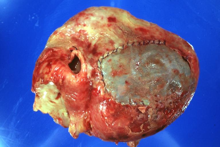 Gross natural color external view of heart with repair patch over ruptured anterior infarction. A horizontal section of fixed ventricles