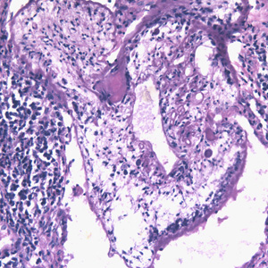 Proliferating sparganum in lung tissue in a patient from Taiwan, stained with H&E. Adapted from CDC