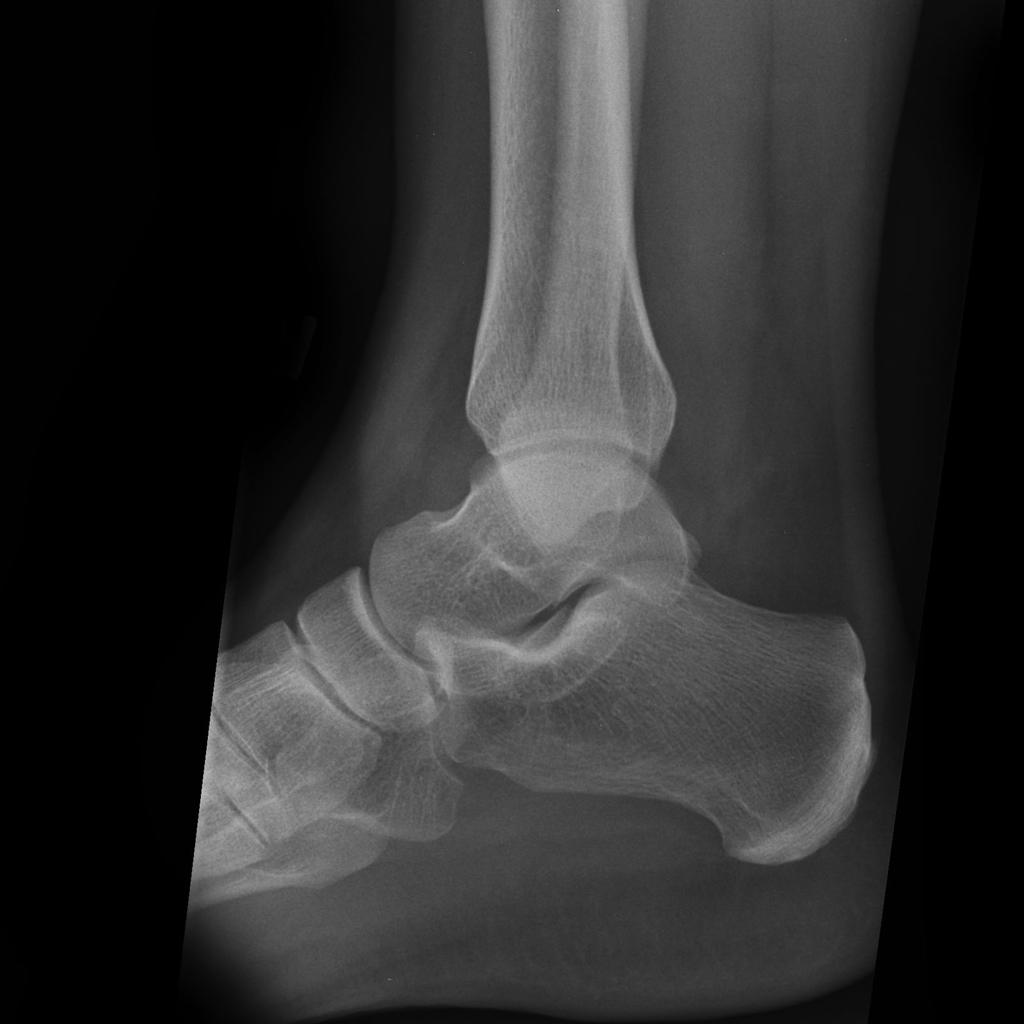 Lateral Three views of the ankle demonstrate a horizontal fracture through the lateral malleolus, below the level of the ankle joint, consistent with a Weber A fracture.