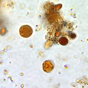 B. hominis cyst-like forms in wet mounts stained in iodine. Adapted from CDC