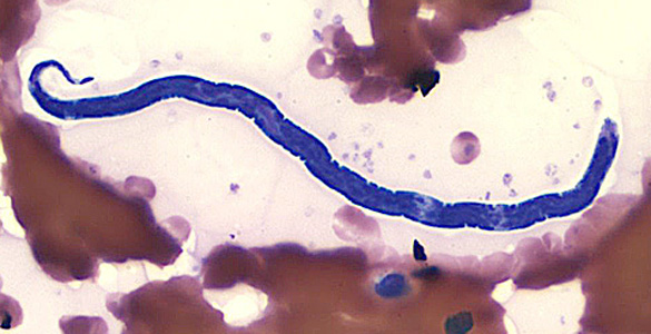 Loa loa microfilaria in thin blood smear (Giemsa stain)