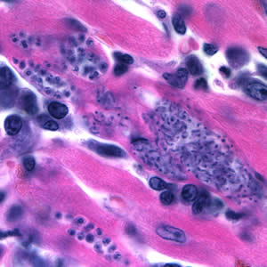Trypanosoma cruzi amastigotes in heart tissue. The section is stained with H&E. Adapted from CDC