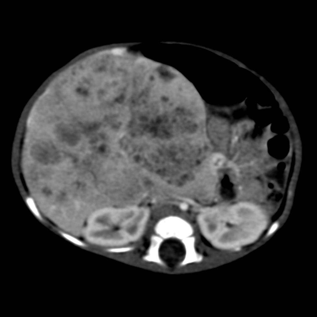 CT shows a large heterogenous predominantly hypodense mass lesion arising from right lobe of liver with a chunky calcification.[2]