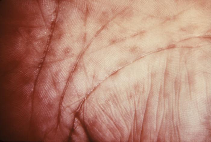 These keratotic lesions on the palms are due to secondary syphilis. Syphilis is a complex sexually transmitted disease (STD) caused by the bacterium Treponema pallidum. It has often been called "the great imitator" because so many of the signs and symptoms are indistinguishable from those of other diseases. Adapted from CDC
