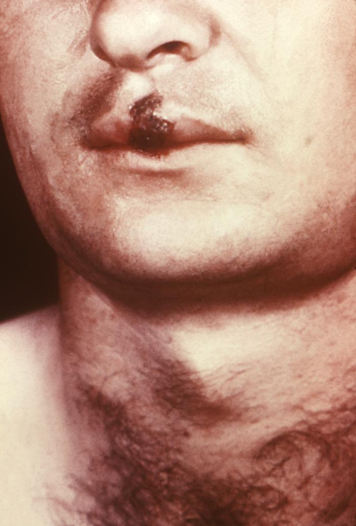 This patient presented with a primary syphilitic chancre of the lip. The primary stage of syphilis is usually marked by the appearance of a sore called a chancre. The chancre is usually firm, round, small, and painless. It appears at the spot where syphilis entered the body, and lasts 3-6 weeks, healing on its own. Adapted from CDC