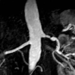 High grade left main renal artery stenosis, MRA. 76 year old male with hypertension.