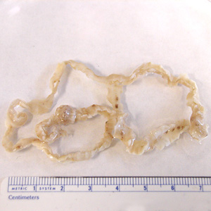 Section of an adult D. latum containing many proglottids. The scolex was not present in this specimen. Image courtesy of the Florida State Public Health Laboratory. Adapted from CDC