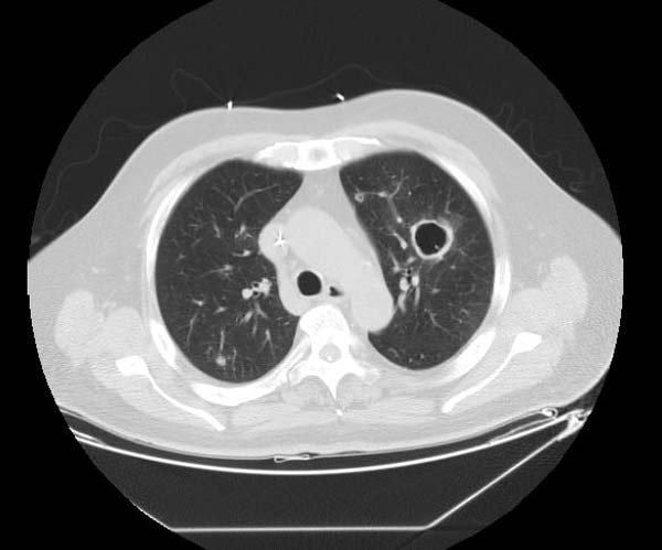 Pulmonary septic emboli
