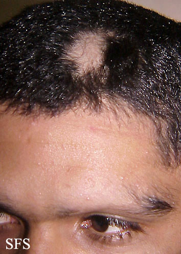 File:Alopecia areata 27.jpeg