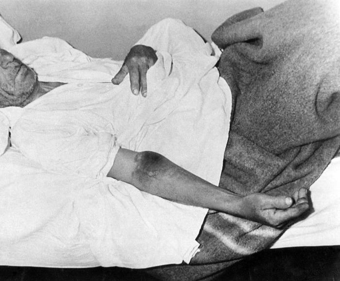 Isolated male patient diagnosed with Crimean-Congo hemorrhagic fever (C-CHF). From Public Health Image Library (PHIL). [12]