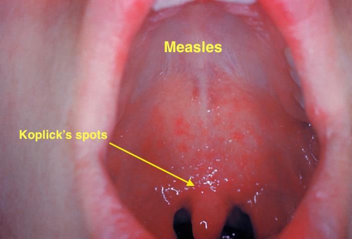 Koplick spots (Measles)