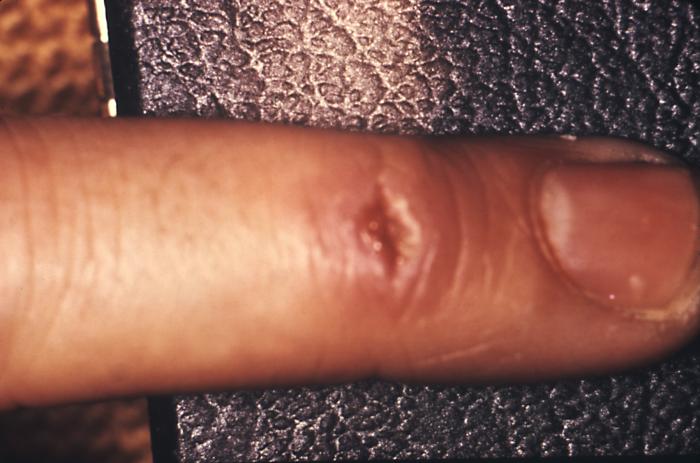 The ulcerative primary syphilitic lesion on this patient's finger was due to lab acquired disease. The primary stage of syphilis is usually marked by the appearance of a single sore known as a chancre, but there may be multiple sores. The chancre is usually firm, round, small, and painless. Adapted from CDC