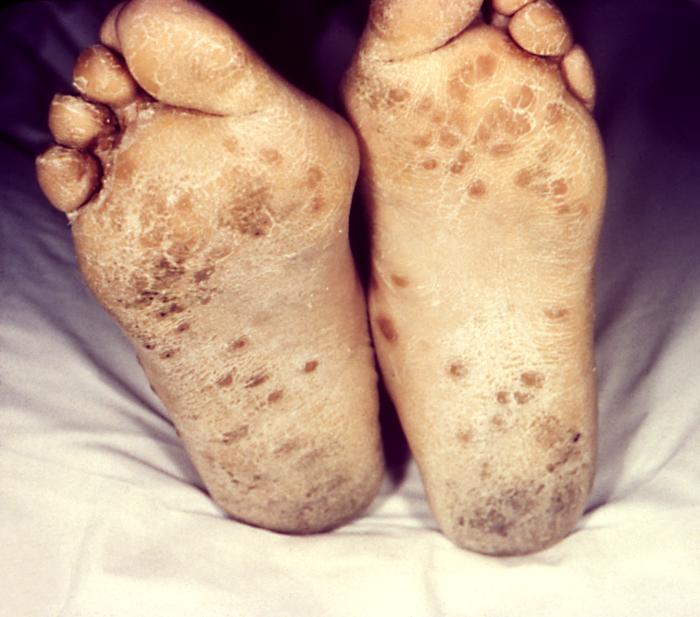 This patient presented with a papulosquamous rash of secondary syphilitic lesions on the plantar surface of his feet. The second stage starts when one or more areas of the skin break into a rash that appears as rough, red or reddish brown spots both on the palms of the hands and on the bottoms of the feet. Even without treatment, rashes clear up on their own. Adapted from CDC