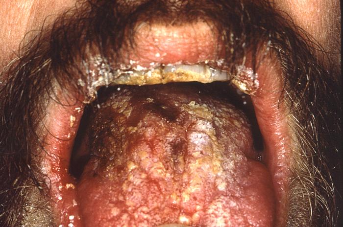 Oral candidiasis infection. From Public Health Image Library (PHIL). [2]