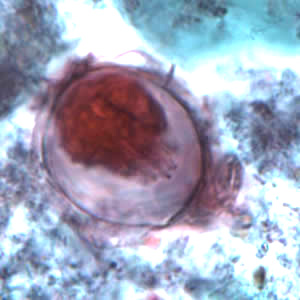 Egg of H. nana in a trichrome-stained stool specimen. Although trichrome is not the preferred method for observing helminth eggs, they can be detected this way. The eggs are distorted, probably due to the zinc polyvinyl alcohol (PVA) used for preserving specimens for trichrome stain. Images courtesy of the Oregon State Public Health Laboratory. Adapted from CDC