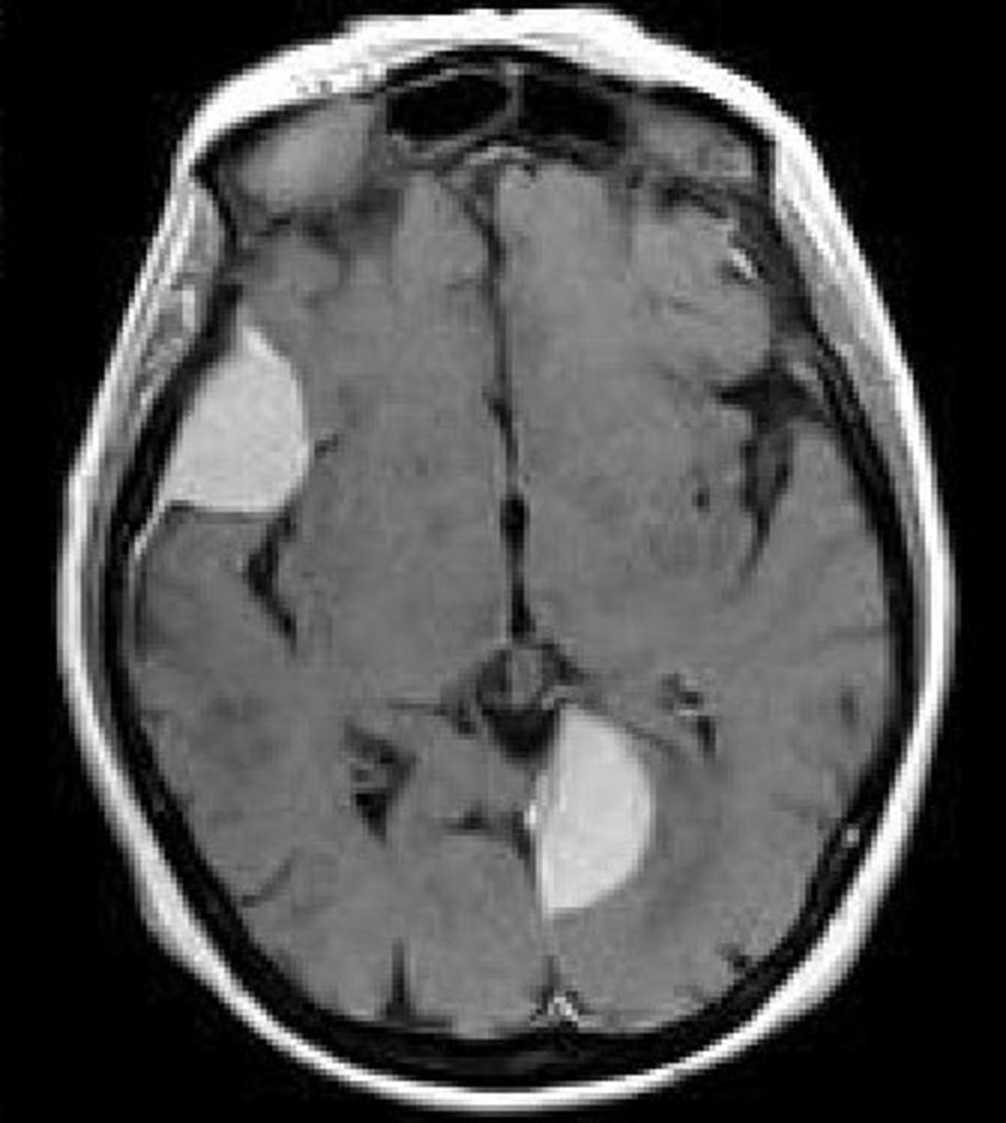 File:Multiple-meningiomas-1.jpg