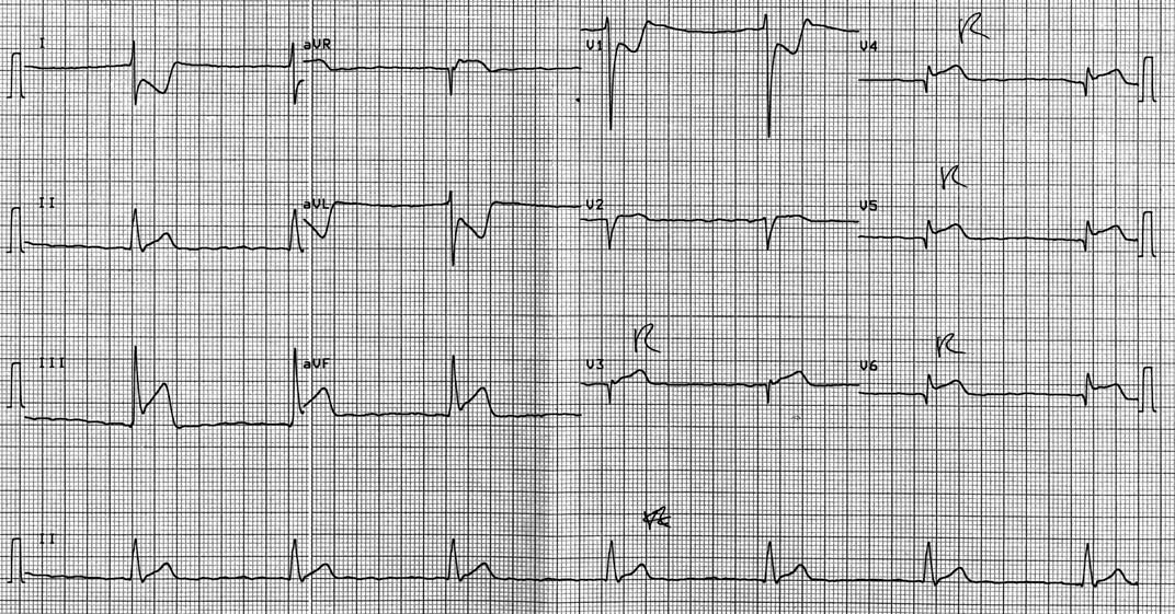 Same patient's 2. EKG; This EKG shows clear ST elevation in the right precordial leads. A coronary angiography revealed a proximal right coronary artery occlusion.