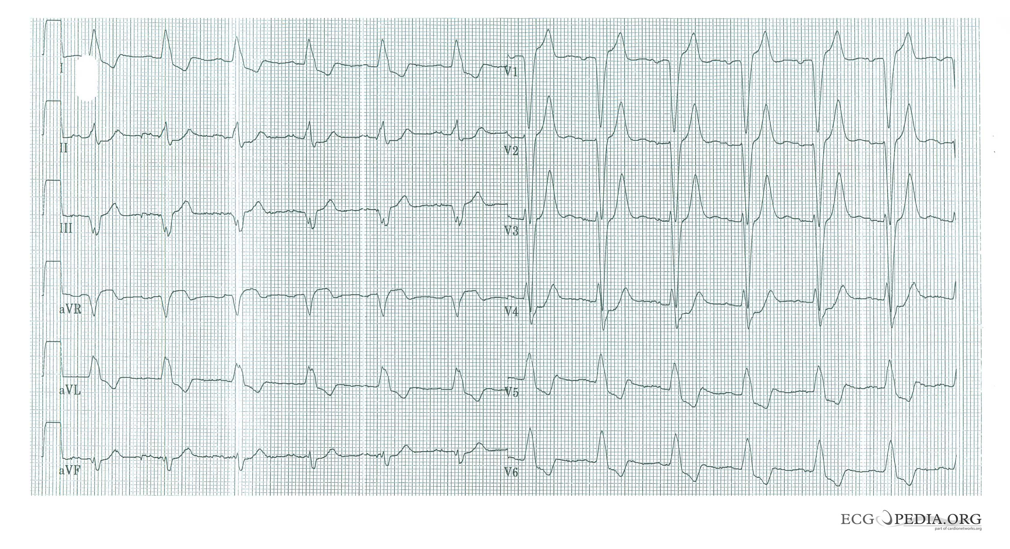 Acute MI in a patient with LBBB