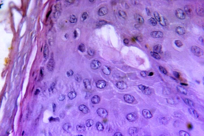 Cytoarchitectural pathologic changes found in a sample of skin tissue from a eczema vaccinatum lesion, which had manifested itself after this patient had received a smallpox vaccination.Adapted from Public Health Image Library (PHIL), Centers for Disease Control and Prevention.[14]