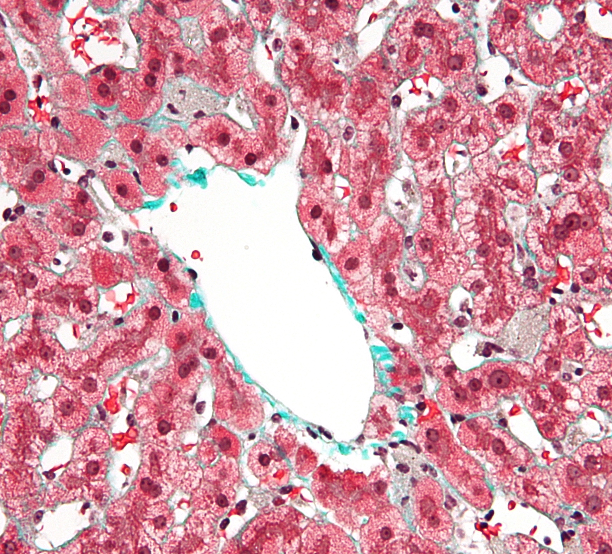 File:Kupffer cells high mag cropped.jpg