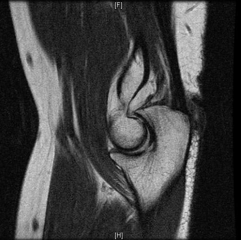 File:Normal-elbow-MRI-005.jpg