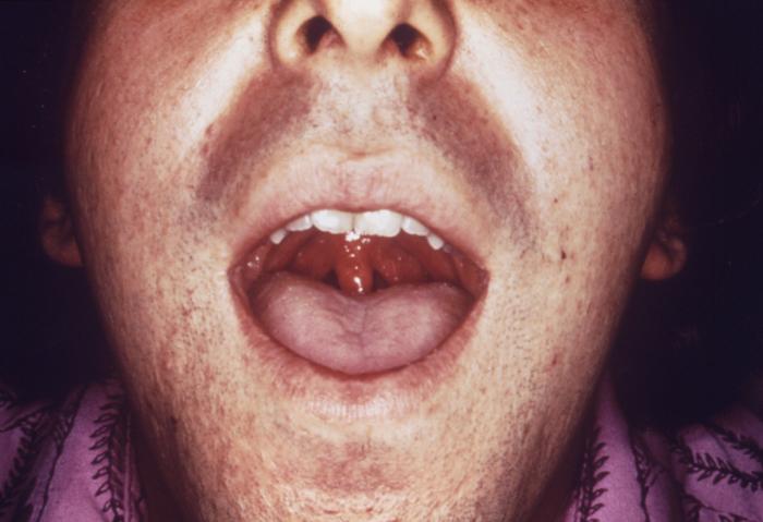 This patient presented with symptoms later diagnosed as due to Gonococcal pharyngitis. Gonococcal pharyngitis is a sexually-transmitted disease acquired through oral sex with an infected partner. The majority of throat infections caused by gonococci have no symptoms, but some can suffer from mild to severe sore throat. Adapted from CDC