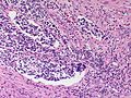 File:120px-Adrenal Neuroblastoma VascularInvasion MP CTR.jpg
