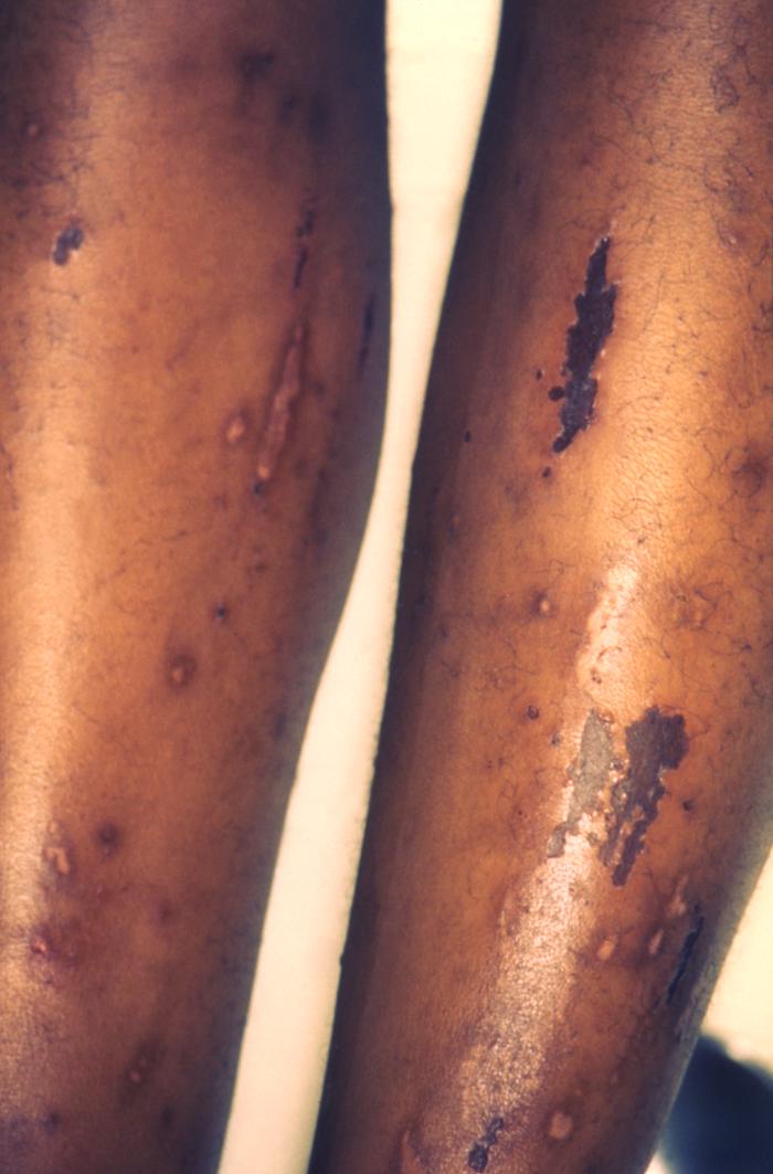 This image depicts the anterior aspect of a patient’s lower legs, either of which displaying the pathologic consequences of an infestation of Sarcoptes scabiei var. hominis, otherwise known as scabies. Of note, were the secondary severe excoriations, resulting from the patient having scratched at the primary maculopapular rash caused by the scabies bites. The most common signs and symptoms of scabies are intense itching (pruritus), especially at night, and a pimple-like (papular) itchy rash. The itching and rash each may affect much of the body or be limited to common sites such as the wrist, elbow, armpit, webbing between the fingers, nipple, penis, waist, belt-line, and buttocks. The rash also can include tiny blisters (vesicles) and scales. Scratching the rash can cause skin sores; sometimes these sores become infected by bacteria. Adapted from CDC