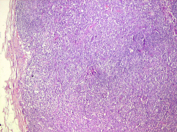 File:Angioimmunoblastic T-cell lymphoma Biopsy 2.jpg