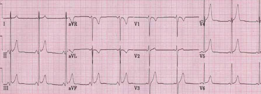 Benign early repolarization with J point elevation, concave shaped up-sloping ST segment, notching of the J point, prominent T waves