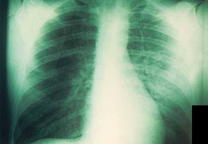 Chest x-ray of a plague patient revealing bilateral infection, greater on the patient's left side, which was diagnosed as a case of pneumonic plague, caused by Yersinia pestis. From Public Health Image Library (PHIL). [18]