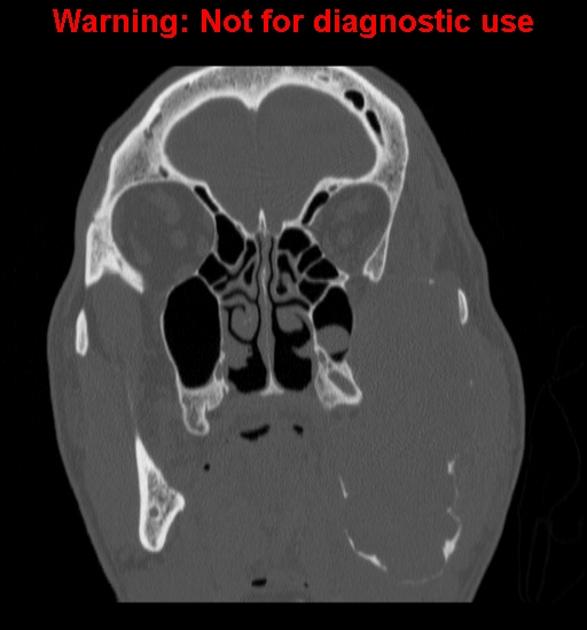 File:Coronal non contrast ameloblastoma x ray.jpg