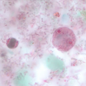 Binucleate form of trophozoites of D. fragilis, stained with trichrome. A cyst-like form of Blastocystis hominis lies to the left of the D. fragilis. Adapted from CDC
