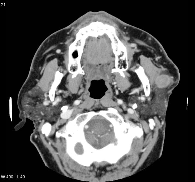 CT showing Mucoepidermoid adenocarcinoma[3]