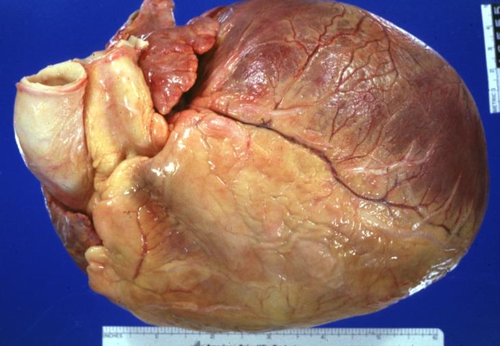 Cardiomyopathy: Gross intact globular shaped heart