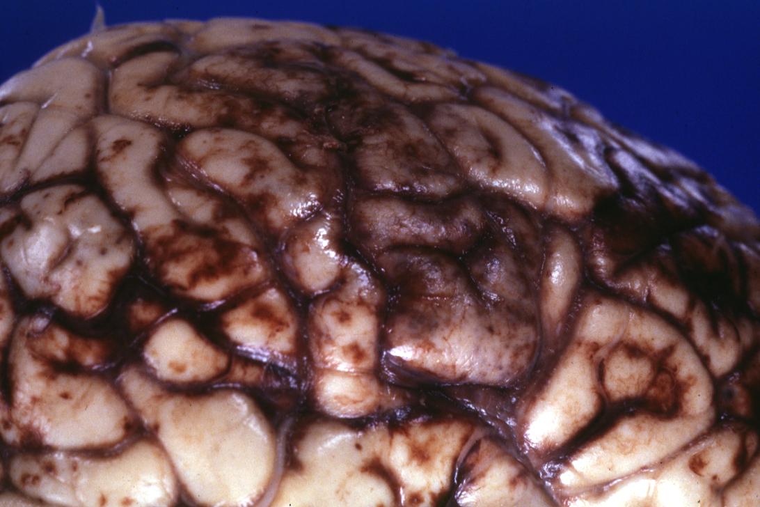 Purpura of cerebrum, cerebellum and brain stem in 36 years old female with Cushing syndrome and bacterial endocarditis caused by Staphylococcus aureus