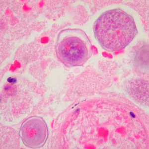 Cysts of B. mandrillaris in brain tissue, stained with H&E. Image courtesy of Cook Children’s Hospital, Fort Worth, Texas. Adapted from CDC