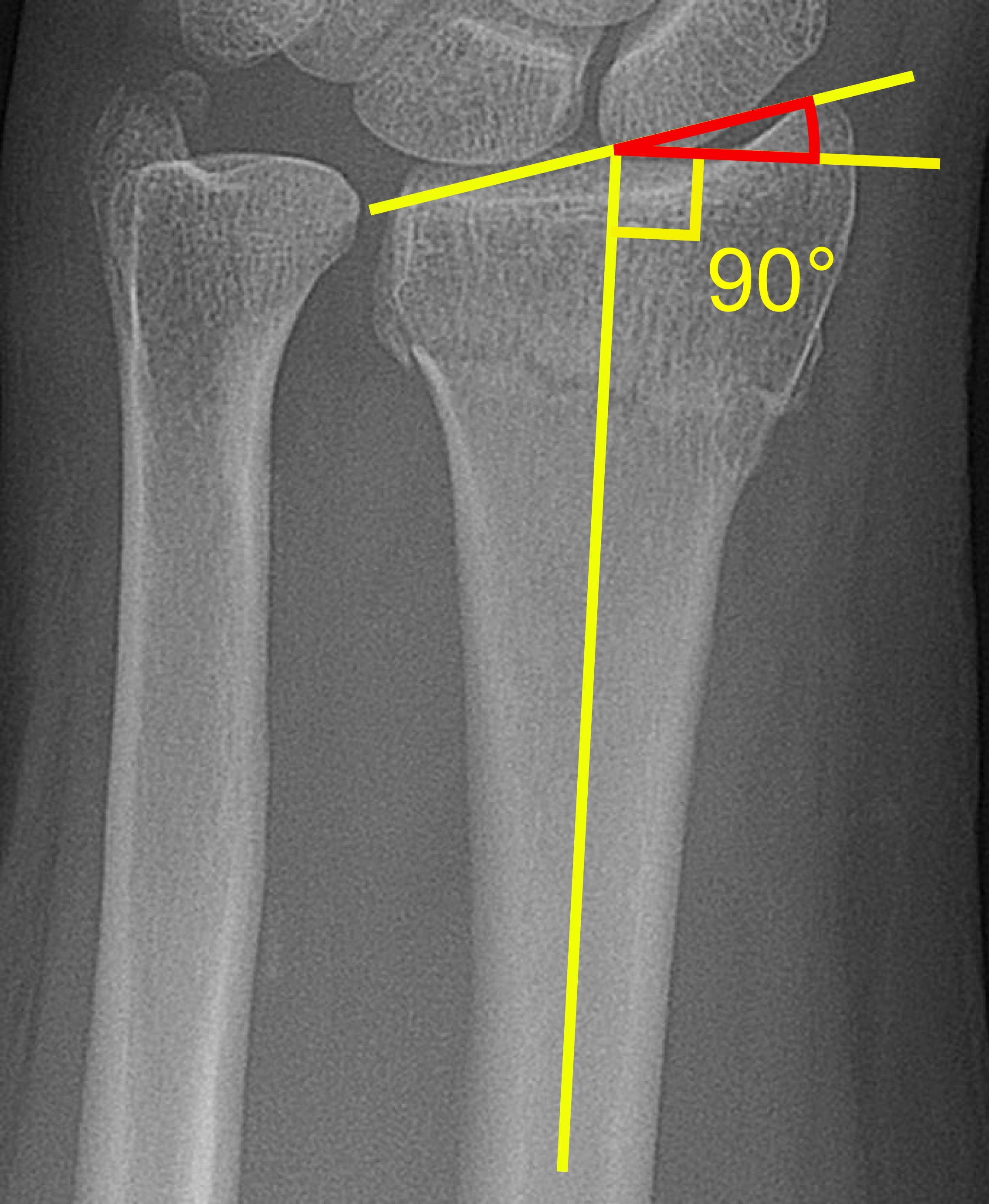 File:Radial inclination of distal radius fracture.jpg