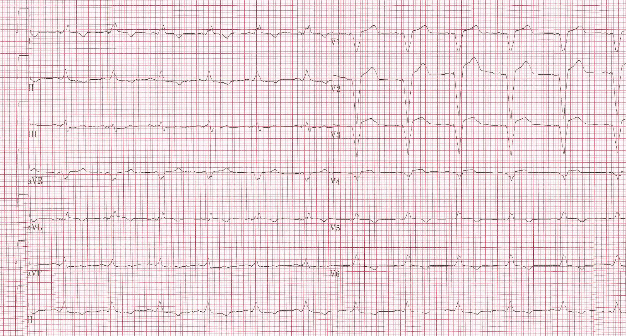 The same patient as in the first example 2 months before the myocardial infarction. Normal LBBB pattern.